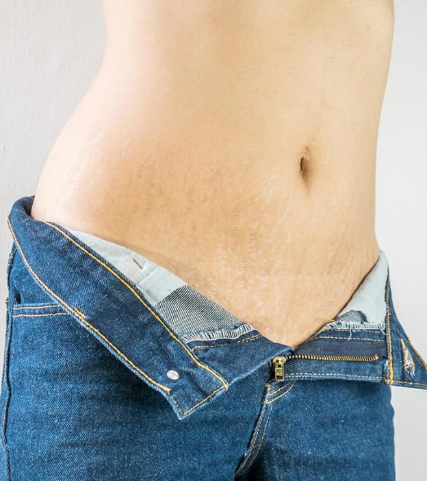 Stretch Marks In Teenagers: How To Deal With Them