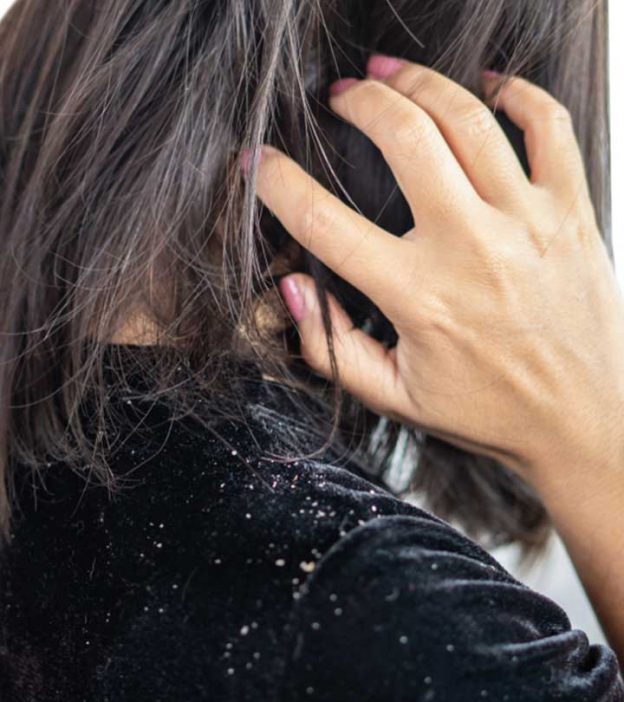 6 Best Hair Oils For Dandruff – Control The Itching & Flaking